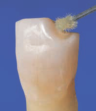 Ecusphere Shape A2 - нанесение бондинга